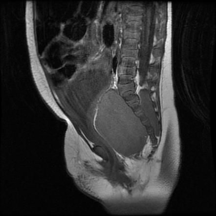 Pelvic neuroblastoma | Image | Radiopaedia.org