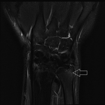 TFCC disc injury and UCCL complete tear (wrist MRI arthrogram) | Image ...