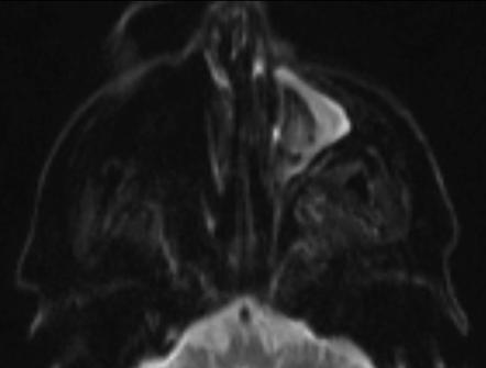 Paranasal sinus mycetoma | Radiology Reference Article | Radiopaedia.org