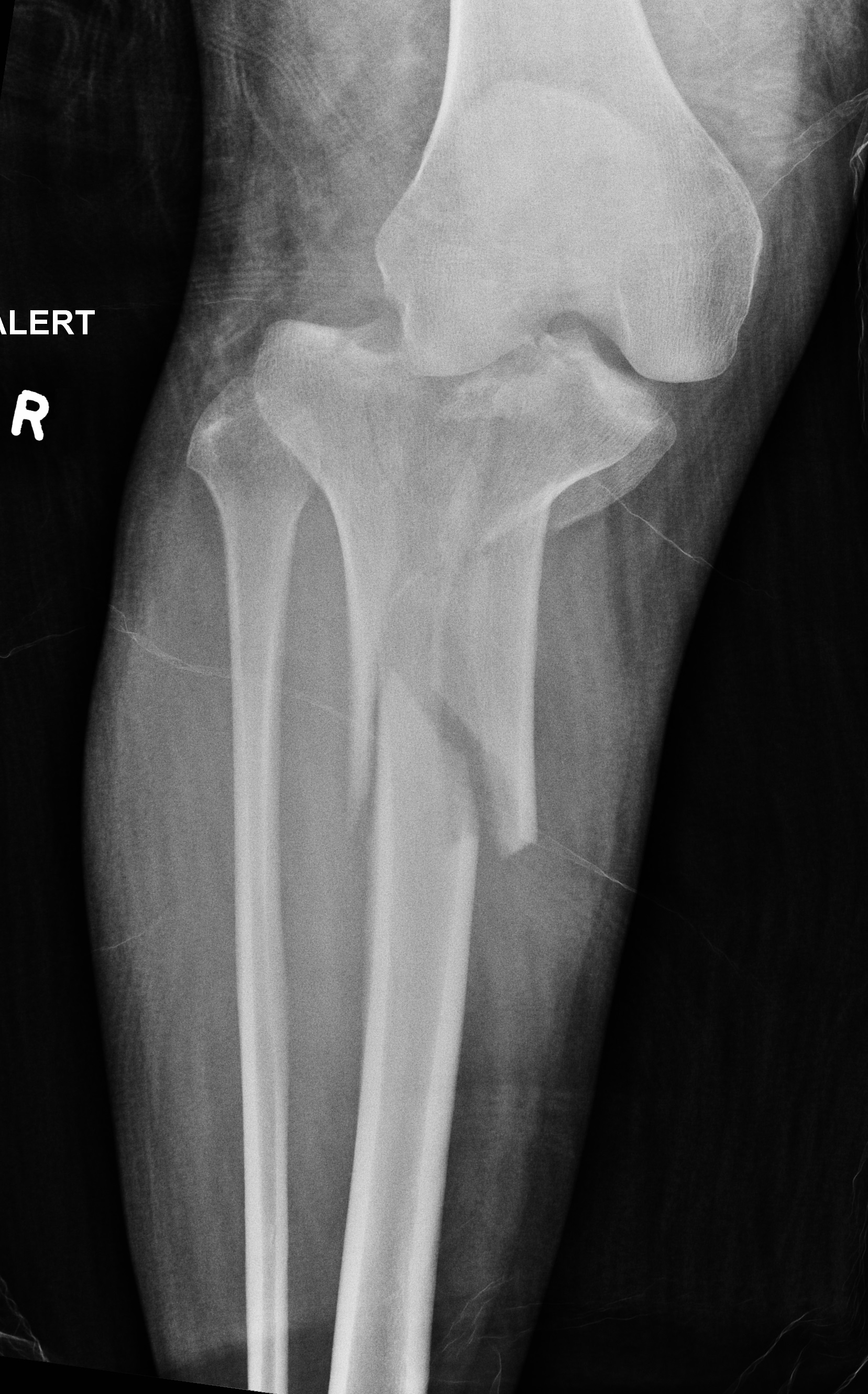 Tibial Plateau Fracture Image 9669