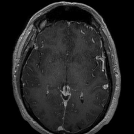 Intracranial dural arteriovenous fistula | Image | Radiopaedia.org