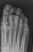 Toes series | Radiology Reference Article | Radiopaedia.org