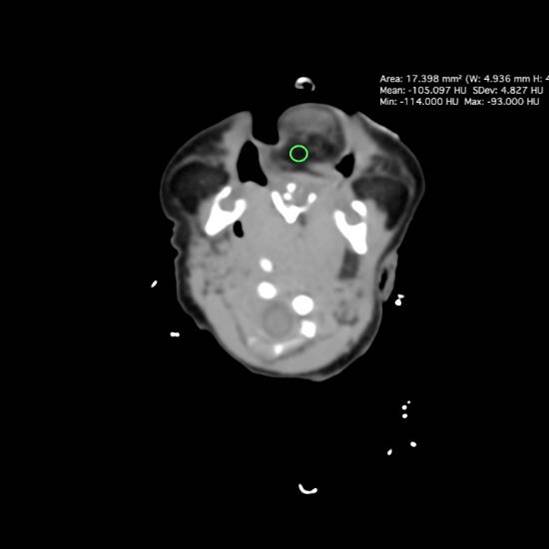 Pituitary Duplication With Nasopharyngeal Teratoma And Cleft Palate