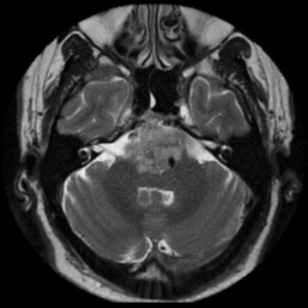 Chordoma | Radiology Reference Article | Radiopaedia.org