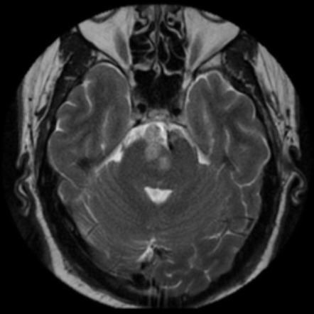 Chordoma | Image | Radiopaedia.org