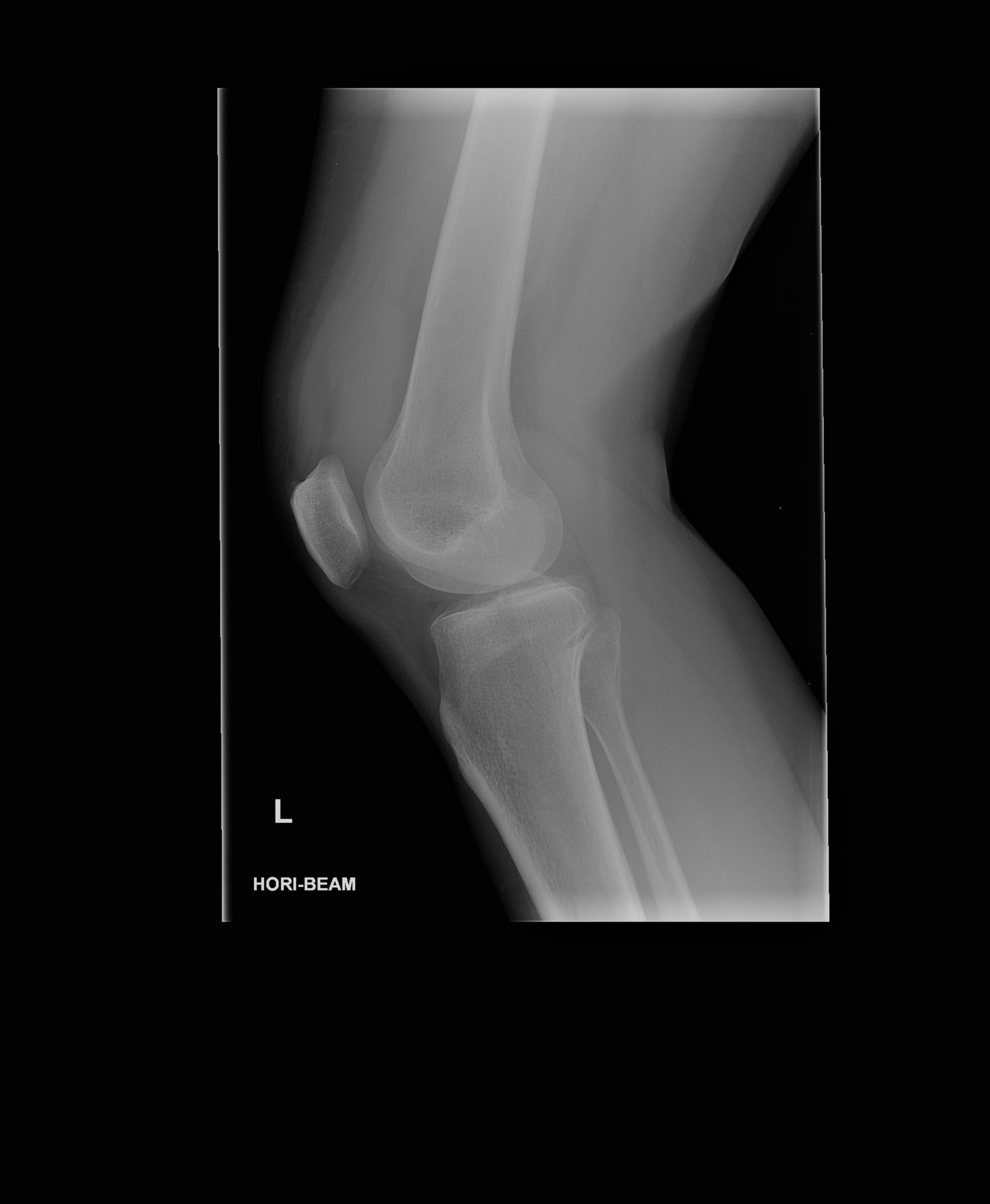 Tibial Plateau Fracture Schatzker Type Iv Image Radiopaedia Org