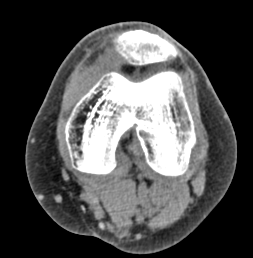 Tibial Plateau Fracture Schatzker Type Iv Image