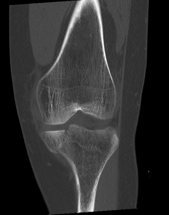 Tibial plateau fracture | Radiology Reference Article | Radiopaedia.org