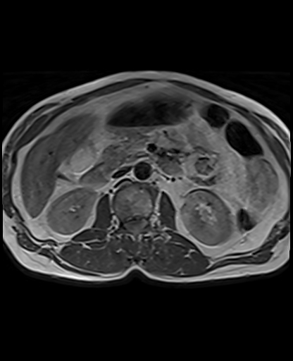 Insulinoma | Image | Radiopaedia.org