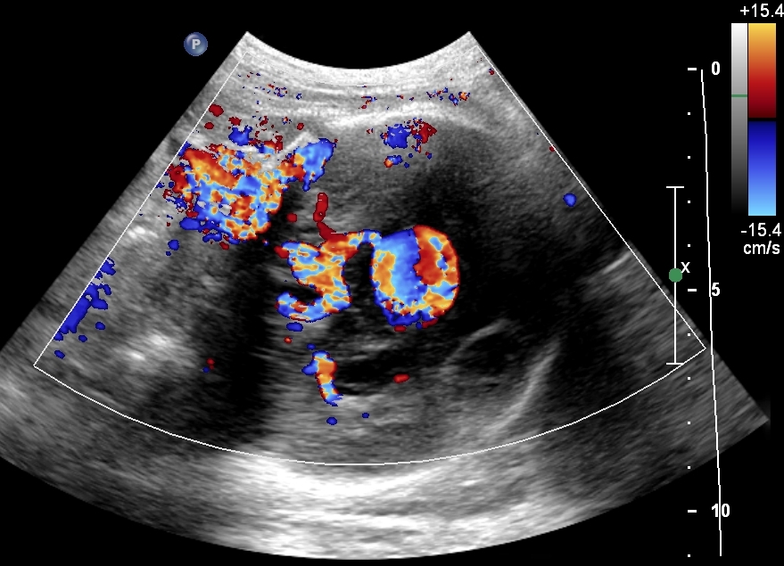 Vein of Galen aneurysmal malformation | Image | Radiopaedia.org