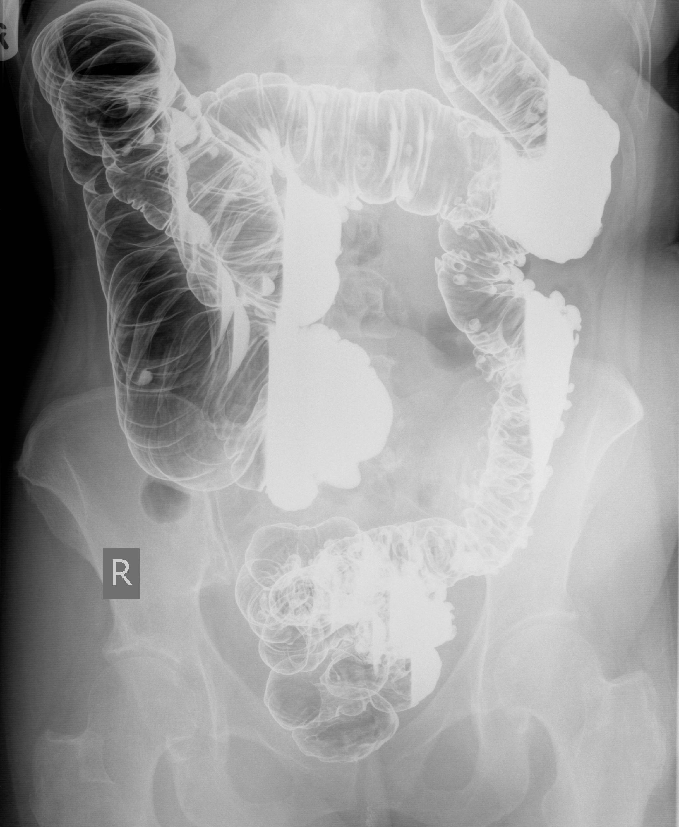 Zenker Diverticulum Image Radiopaediaorg