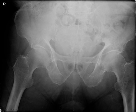 Greater Trochanteric And Incomplete Intertrochanteric Fracture | Image ...