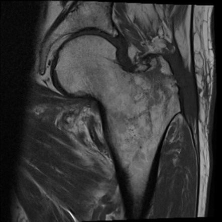 Greater Trochanteric And Incomplete Intertrochanteric Fracture