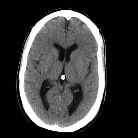 Intraventricular hemorrhage | Radiology Reference Article | Radiopaedia.org