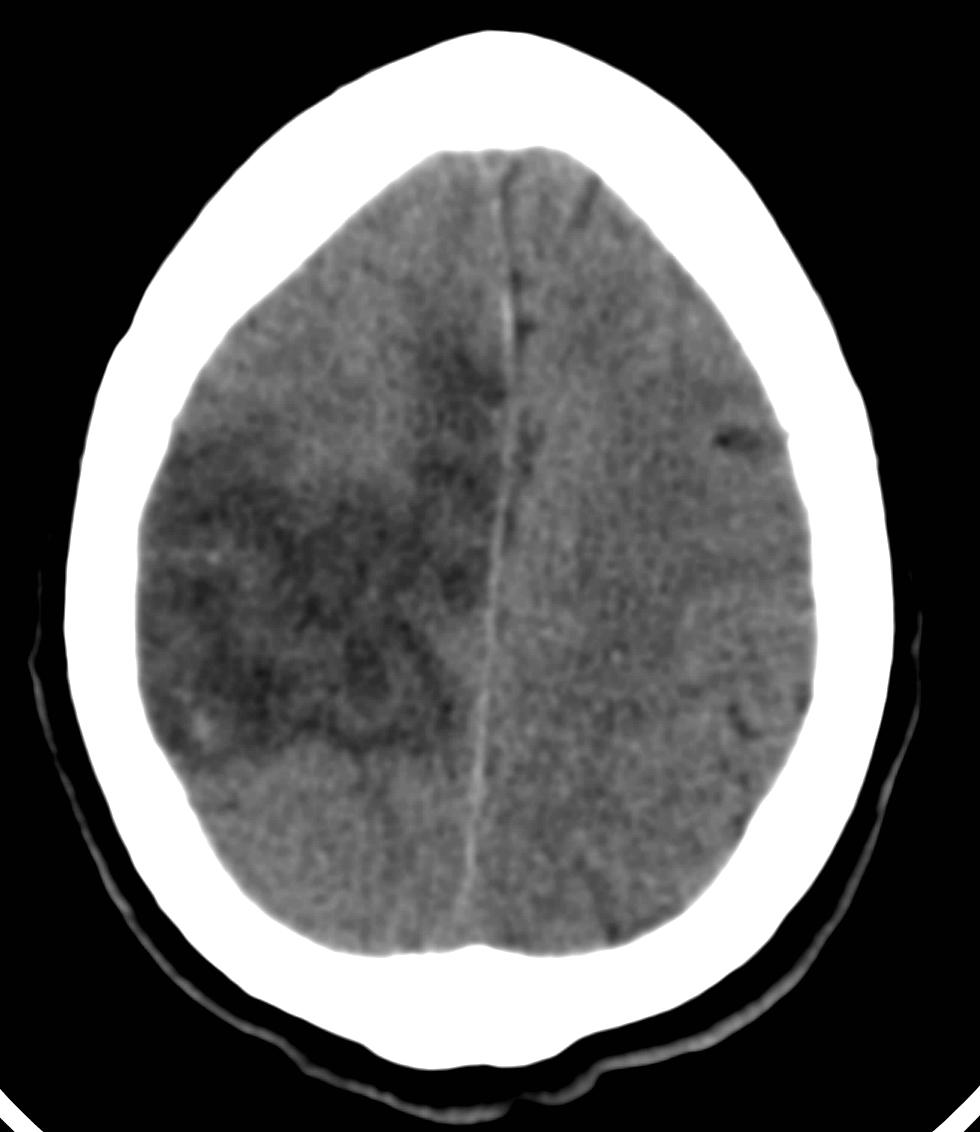 File:Subfalcine herniation from complete MCA infarct, complicated by ...