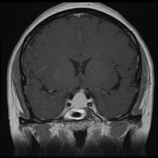 Rathkes Cleft Cyst Image 6878