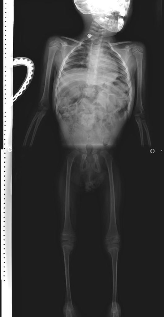 Caudal Regression Syndrome Radiology Case Radiopaedia Org