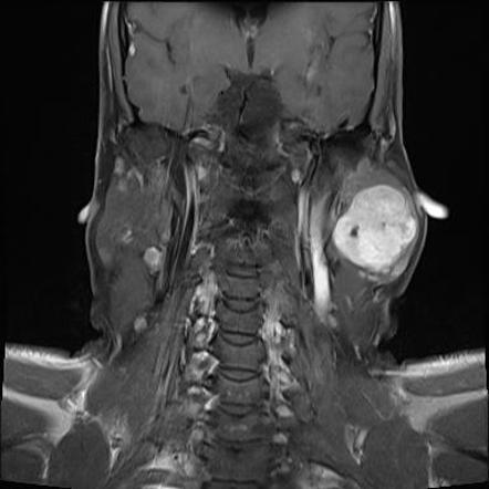 Pleomorphic Adenoma Of The Salivary Glands Radiology Reference