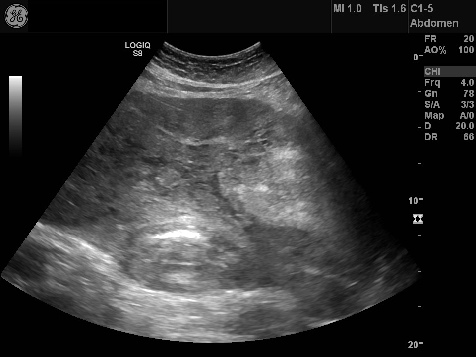 Retroperitoneal liposarcoma | Image | Radiopaedia.org