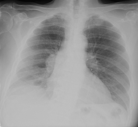 Dense hilum sign | Radiology Reference Article | Radiopaedia.org