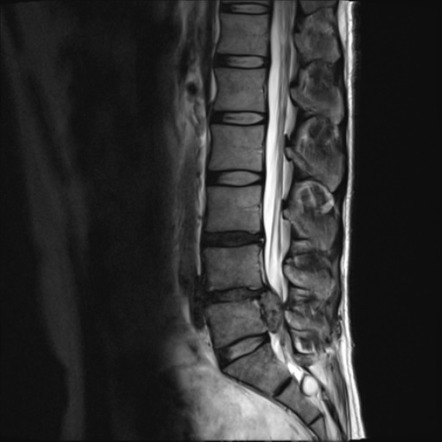 Disc extrusion | Radiology Reference Article | Radiopaedia.org