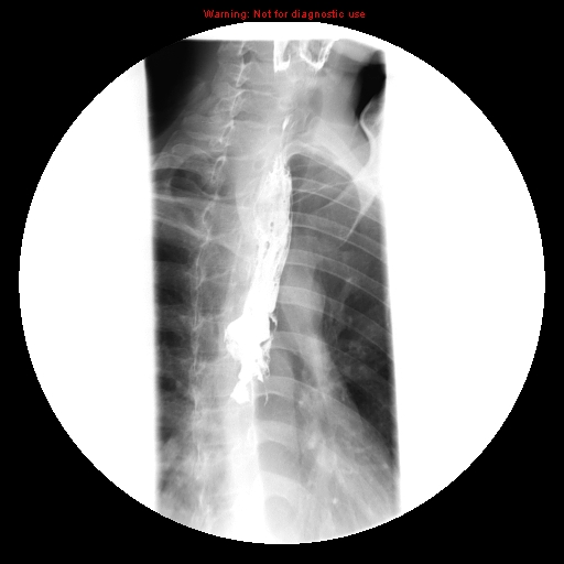 Esophageal Squamous Cell Carcinoma Image