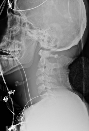 Hypoxic Ischemic Injury, Diffuse Axonal Injury And Atlanto-occipital 