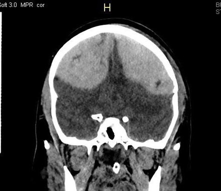 Bilateral frontal acute epidural hematoma | Image | Radiopaedia.org