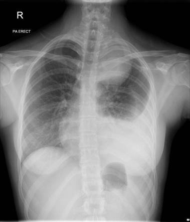 Synovial cell sarcoma | Radiology Case | Radiopaedia.org