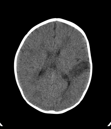 Acute disseminated encephalomyelitis (ADEM) | Radiology Case ...