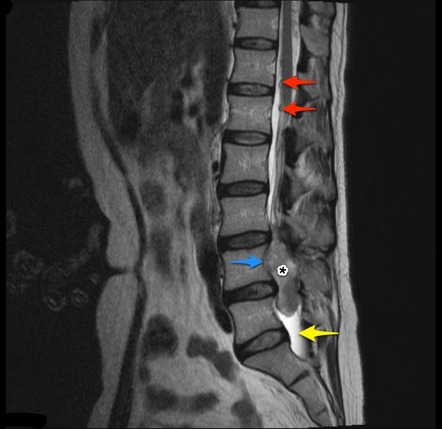 Cauda equina neuroendocrine tumor | Image | Radiopaedia.org