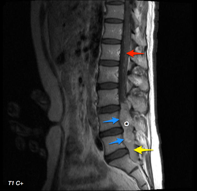 Cauda equina neuroendocrine tumor | Image | Radiopaedia.org