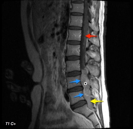 Cauda Equina Neuroendocrine Tumor 