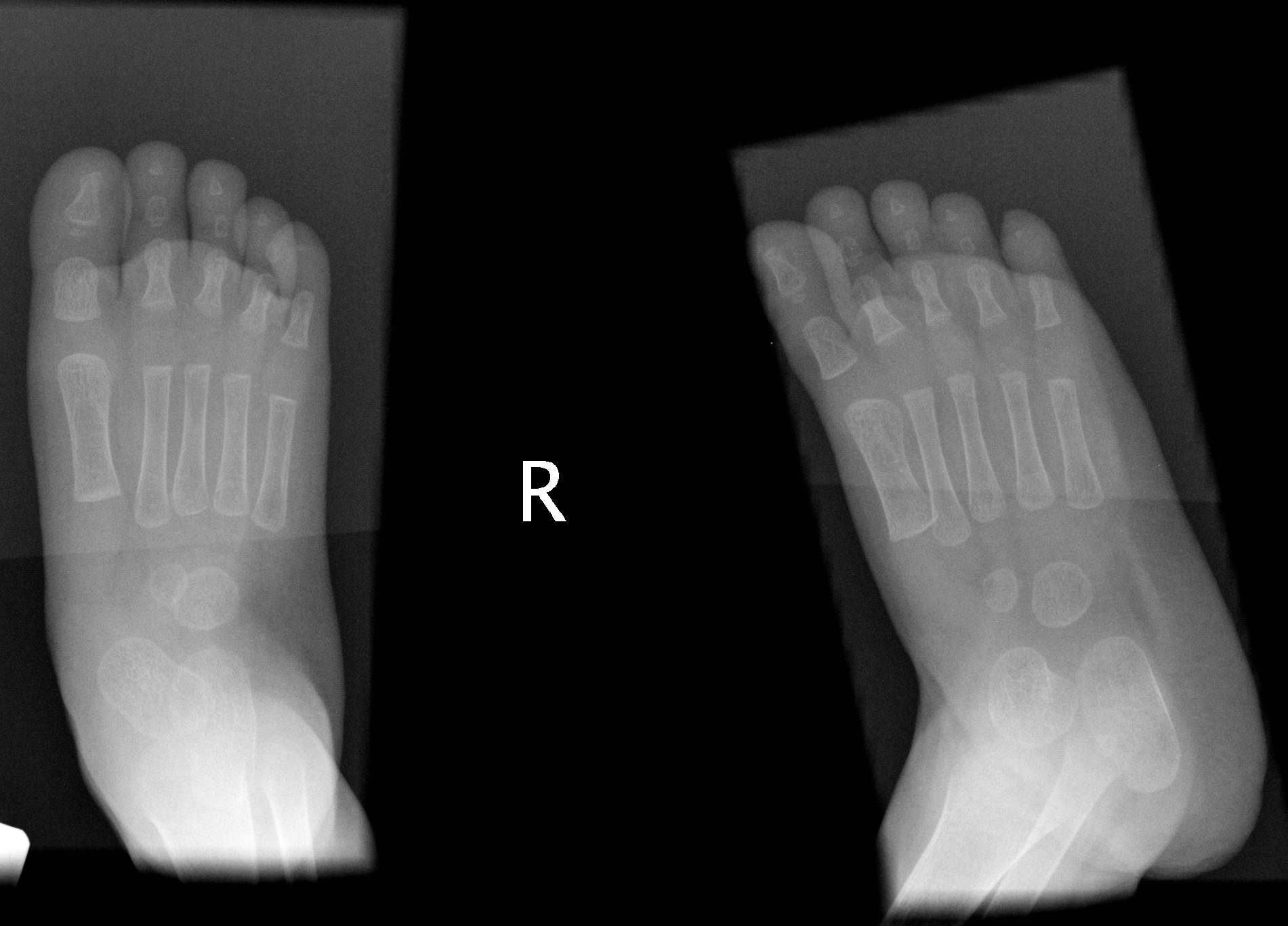 Congenital Vertical Talus Image