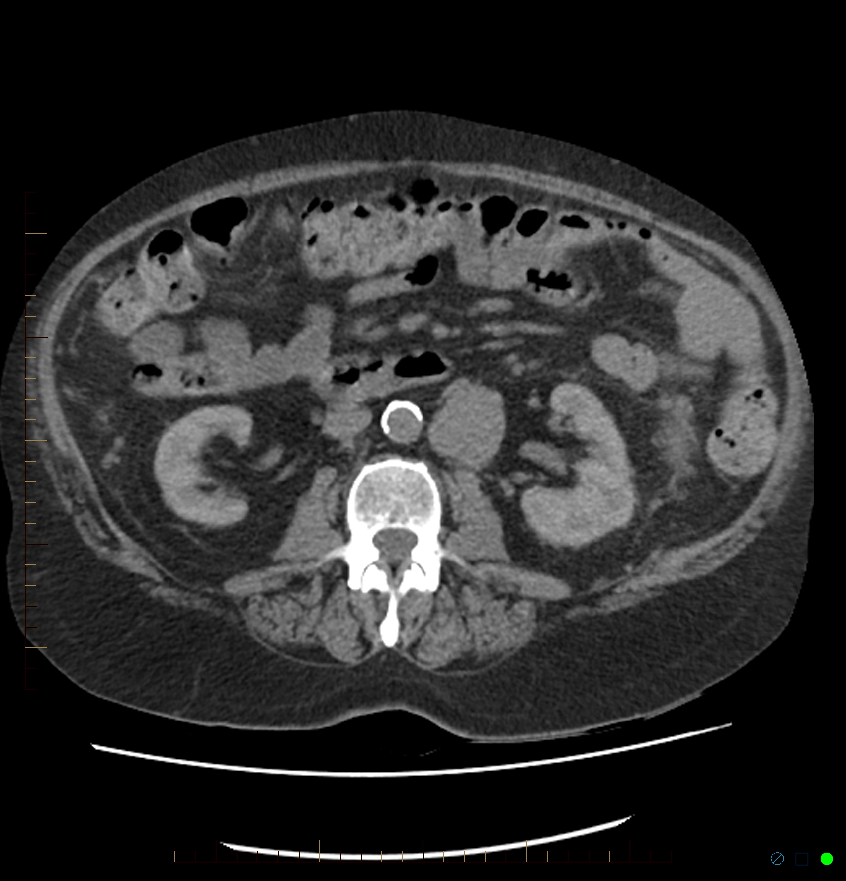 Acute renal failure post IV contrast injection: CT findings | Image ...