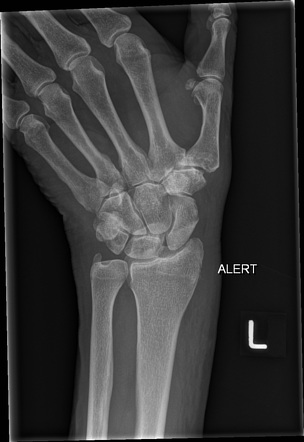 Triquetral and radial styloid fracture | Image | Radiopaedia.org