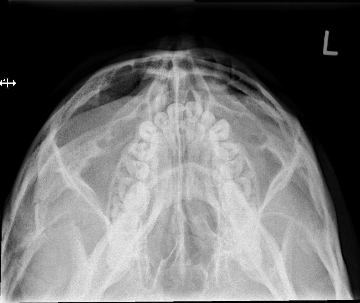 Zygomatic arch fracture | Image | Radiopaedia.org