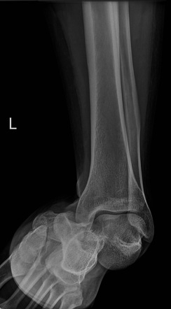 Talar dislocation | Radiology Case | Radiopaedia.org