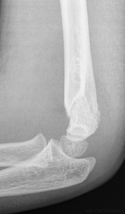 Supracondylar fracture | Radiology Case | Radiopaedia.org