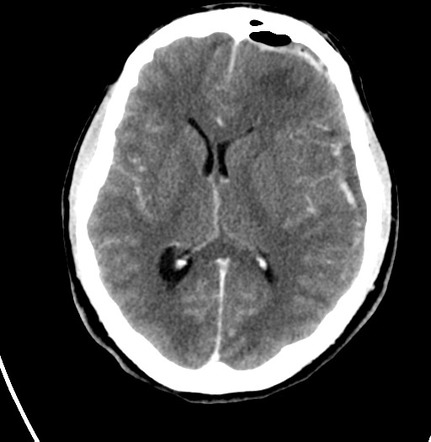 Subdural empyema | Image | Radiopaedia.org