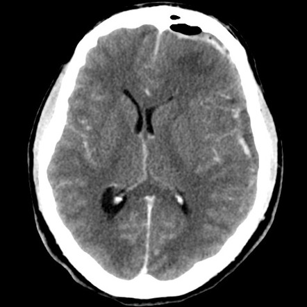 Subdural empyema | Image | Radiopaedia.org