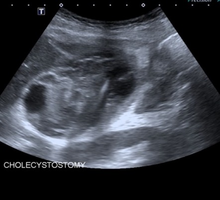 Acute cholecystitis with contained perforation | Image | Radiopaedia.org