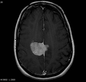 Meningioma - bright on T2 | Radiology Case | Radiopaedia.org