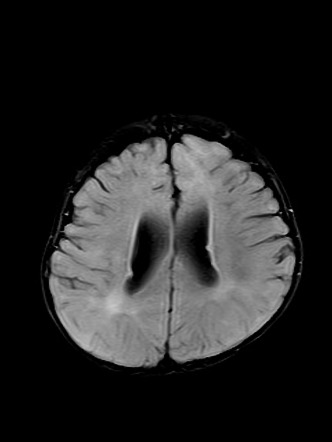 Tuberous sclerosis | Radiology Case | Radiopaedia.org