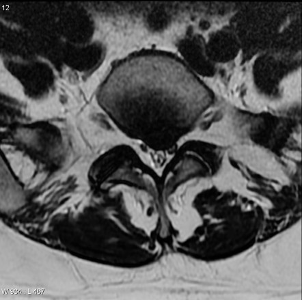 Disc Protrusion Radiology Reference Article Radiopaedia Org