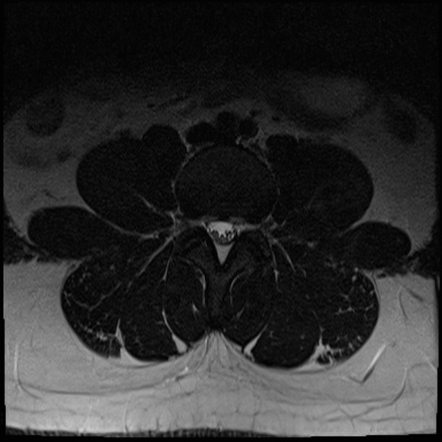 Lumbar spine protocol (MRI), Radiology Reference Article