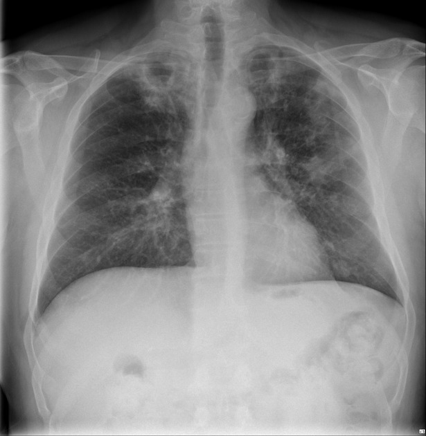 Post-primary pulmonary tuberculosis | Image | Radiopaedia.org