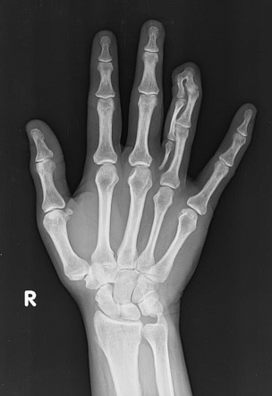 Polysyndactyly | Radiology Reference Article | Radiopaedia.org