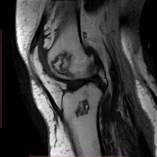 Double line sign, Radiology Reference Article