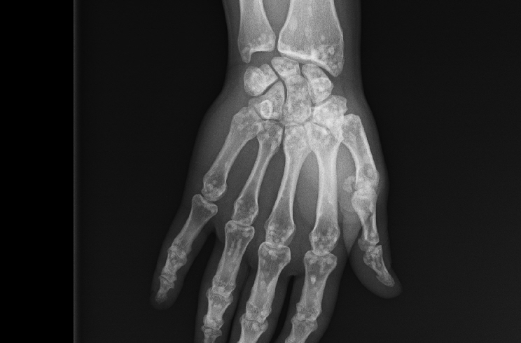 Osteopoikilosis | Image | Radiopaedia.org